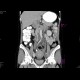Tumorous mass in vena cava inferior: CT - Computed tomography